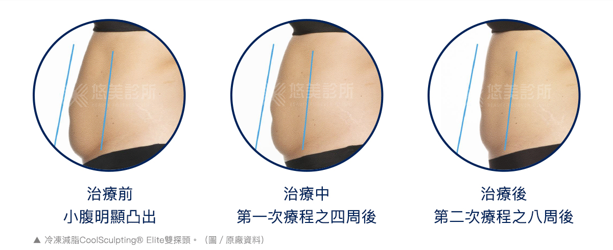 二代酷塑冷凍減脂術前術後對照圖