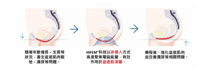 Emsella骨盆儀