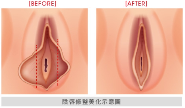 Emsella骨盆儀